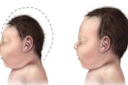 Nguyên nhân gây tật đầu nhỏ ở trẻ sơ sinh?