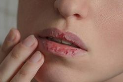 Khi môi bị nứt nẻ