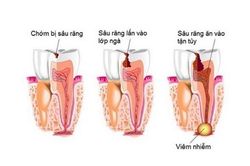 Đề phòng biến chứng viêm xương tủy hàm