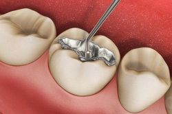 Các đối tượng không nên dùng chất trám răng chứa thủy ngân