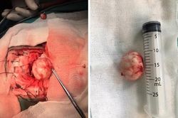 Phẫu thuật u màng não rãnh khứu kích thước lớn cho cụ bà 81 tuổi
