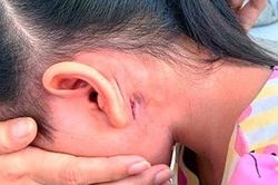 4 người ở Quảng Trị mắc Whitmore tử vong