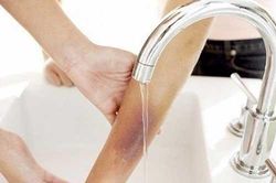 Các biện pháp ngăn ngừa hình thành sẹo bỏng đơn giản ngay tại nhà