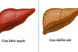 Gan nhiễm mỡ có nguy hiểm?