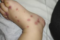 Tưởng vết ban đơn thuần, ai ngờ mắc bệnh cực hiếm Việt Nam chưa ghi nhận