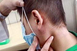 Gia tăng các ca mắc bệnh Whitmore, bệnh có lây từ người sang người?