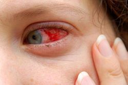 Điều trị biến chứng đau mắt đỏ: Tuyệt đối tuân thủ chỉ định của bác sĩ và không chủ quan