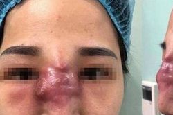 Biến chứng khi làm đẹp tại các cơ sở 'chui'
