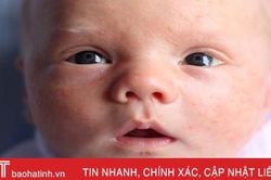 5 dấu hiệu nhận biết trẻ sơ sinh có làn da nhạy cảm