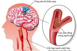 Cảnh giác với cơn thiếu máu não thoáng qua
