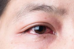 Gai người trước những hình ảnh triệu chứng của bệnh đau mắt đỏ