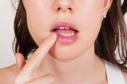 Điều trị nhiệt miệng đúng cách để tận hưởng trọn vẹn cuộc sống