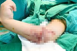 TPHCM: Nối thành công cánh tay bị đứt lìa cho bệnh 8 tuổi