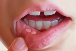 Chớ xem thường loét niêm mạc miệng