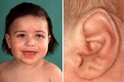 Đôi tai tiết lộ về sức khỏe của bạn