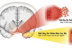 Cần theo dõi sức khỏe hàng ngày, nhận biết các dấu hiệu đột quỵ sớm