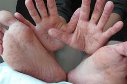 Bệnh tay chân miệng có lây không? Đối tượng nào dễ mắc bệnh?
