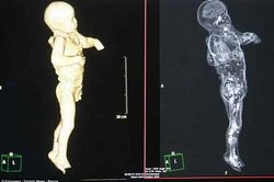 Chụp CT thi thể 'hóa đá' của nạn nhân thảm họa Pompeii: 'Cái chết của họ quá khủng khiếp'