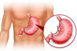 Nguyên nhân gây xuất huyết tiêu hóa