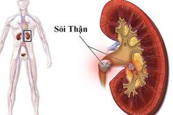 Nguy cơ sỏi thận vì 3 thói quen hầu như ai cũng mắc phải