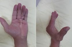 Làm gì khi bị đau co rút bàn tay?