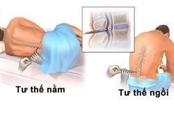 Nguy cơ khi chọc dò tủy sống