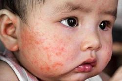 Kem chàm sữa cho trẻ: Những điều mẹ cần biết!