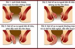Ngừa bệnh trĩ ở người cao tuổi