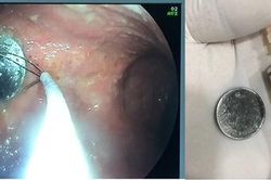 Đồng xu đường kính 2cm trong dạ dày bé gái 4 tuổi