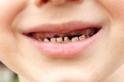 Cách chữa sún răng cho trẻ hiệu quả