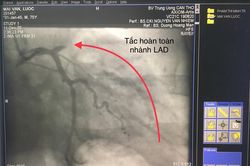 Trời lạnh tác động đến bệnh tim thế nào?