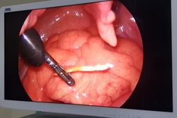 Điều trị thành công xương cá đâm thủng ruột non