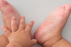 Phân biệt tay chân miệng và viêm họng: Dấu hiệu nhận biết và phòng tránh bằng cách nào?