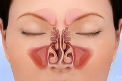 Biến chứng do vẹo vách ngăn mũi