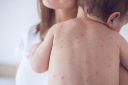 Bệnh thủy đậu có lây không? Những điều cần lưu ý để phòng tránh lây bệnh