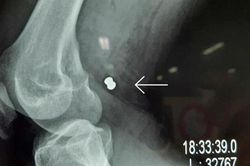 Cứu sống nam thanh niên bị trúng đạn