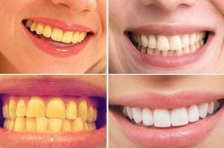 Khắc phục tình trạng răng nhuốm màu