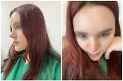 Pha nâng mũi 'đi vào lòng đất', dân mạng gọi đó là 'cầu trượt'