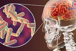 Dấu hiệu viêm màng não mủ ở người trưởng thành
