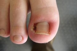 Lý giải nguyên nhân móng chân mọc ngược