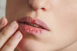 Giải quyết dứt điểm tình trạng môi khô
