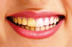 Xử lý răng ố vàng nhờ 4 cách đơn giản