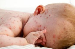 Ghi nhớ 5 lưu ý sau để dùng thuốc điều trị thủy đậu an toàn
