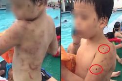 Bé trai với chi chít vết sẹo, lỗ thủng trên cơ thể nghi bị cha đẻ bạo hành