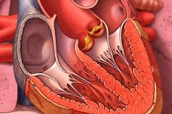 Viêm nội tâm mạc do nhiễm khuẩn răng miệng