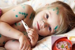 Bị thủy đậu không nên ăn những thứ này nếu không muốn bị sẹo