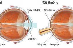 Atropine nhỏ mắt có làm chậm lại tiến triển cận thị ở trẻ em?