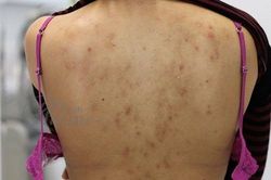 Tắm bằng nước này mụn ở lưng sẽ biến mất chỉ trong 1 tuần