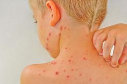 Tại sao thủy đậu gây ngứa? Các biện pháp giảm ngứa khi bị thủy đậu là gì?