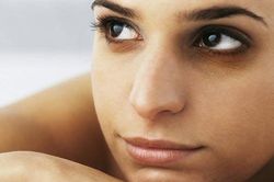 Loại bỏ thâm mắt chỉ bằng cách dùng dưa chuột